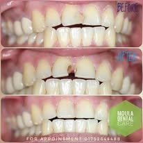 Dental Implant Surgery